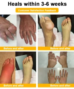 HOOMWELL™ Botulinum Toxin & Bee Venom Pain-Relief Bone Healing Cream