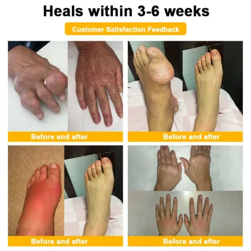 HOOMWELL™ Botulinum Toxin & Bee Venom Pain-Relief Bone Healing Cream