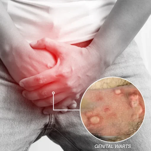 NiseCore® HPV Genital Warts Relief Cream - Image 2