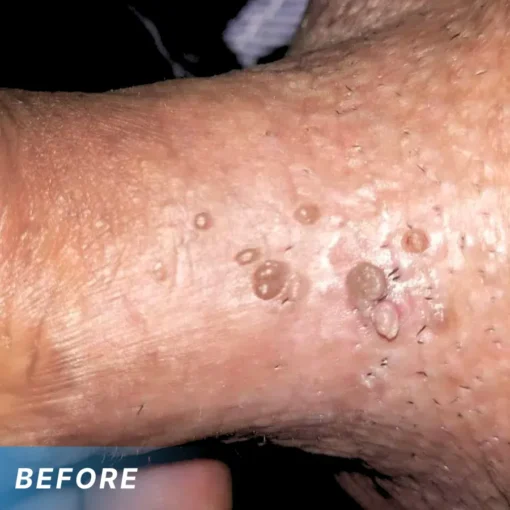 NiseCore® HPV Genital Warts Relief Cream - Image 3