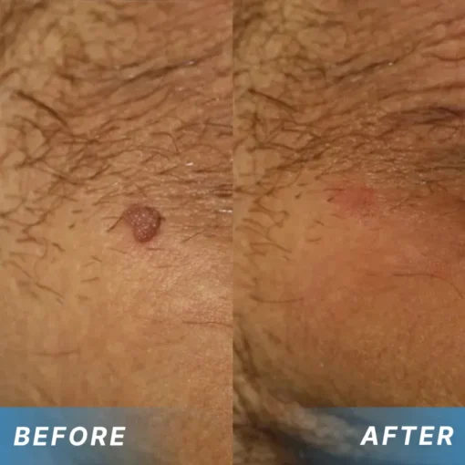 NiseCore® HPV Genital Warts Relief Cream - Image 4