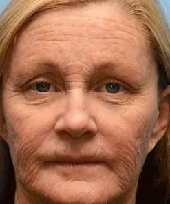 STDEI® BOTOX & VITA A RETINOL SHOT Wrinkle Lift Tightening Cream