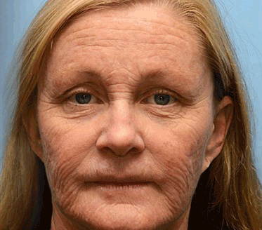 STDEI® BOTOX & VITA A RETINOL SHOT Wrinkle Lift Tightening Cream